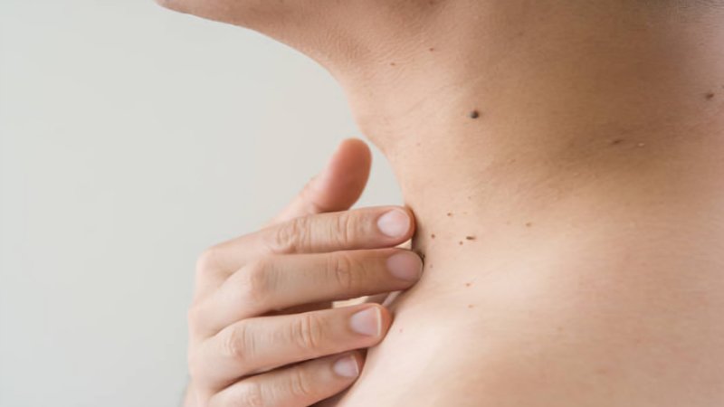 Natural Skin Tag