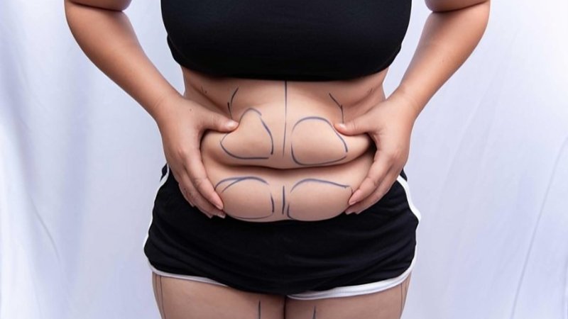 fat melting injection