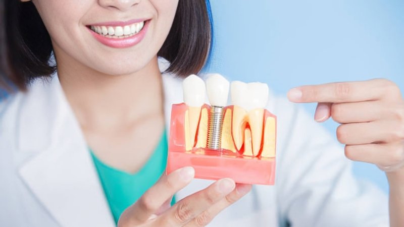dental implants